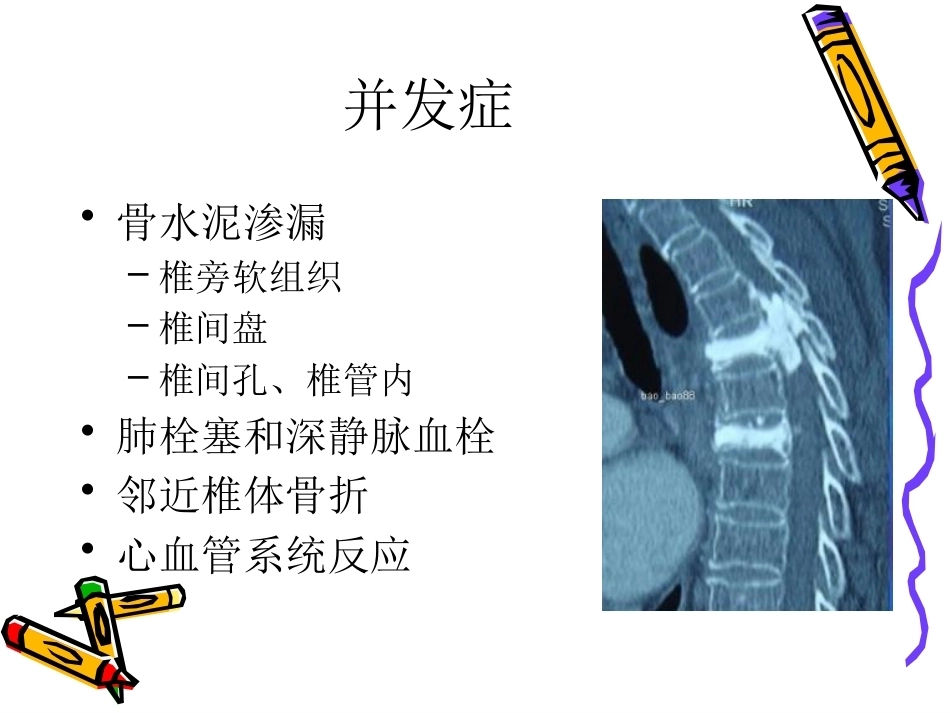 6椎体成形术手术步骤_第9页