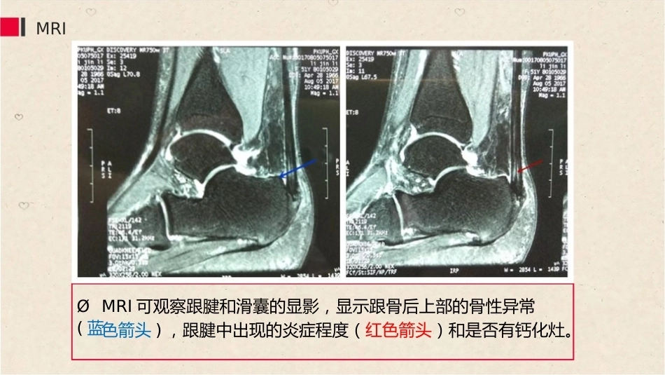 38.关节镜治疗Haglund综合征_第9页