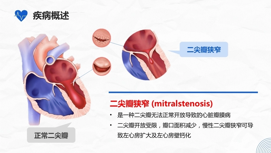 二尖瓣狭窄病人的护理_第4页