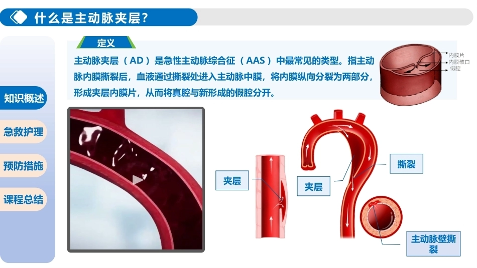 主动脉夹层破裂的急救护理_第5页