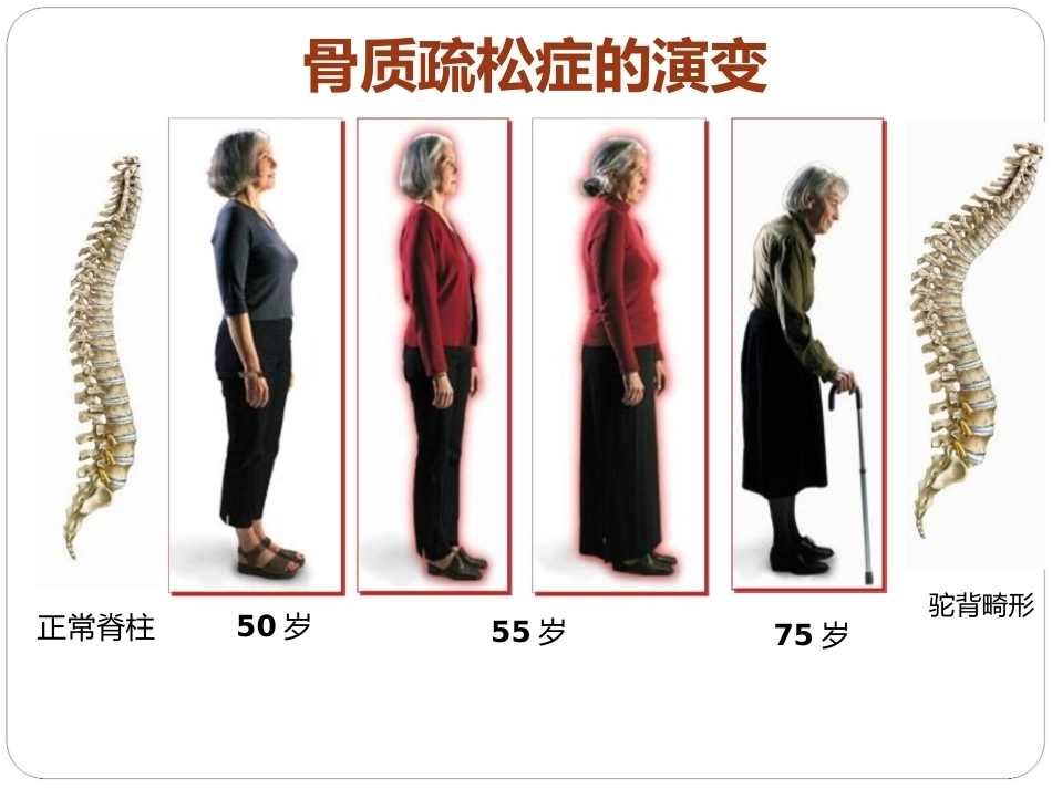 认识骨质疏松(最终版)_第3页