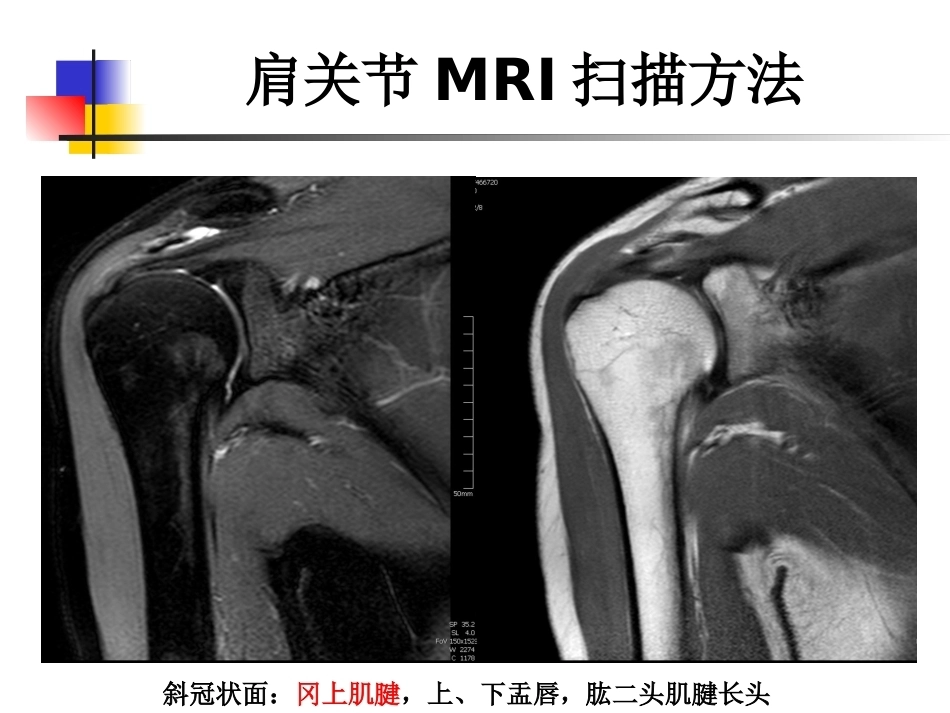 肩关节病变MRI解剖和诊断课件_第11页