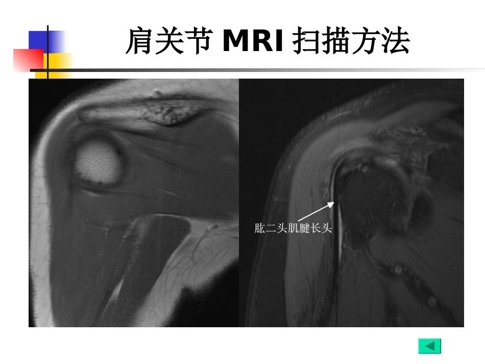 肩关节病变MRI解剖和诊断课件_第12页