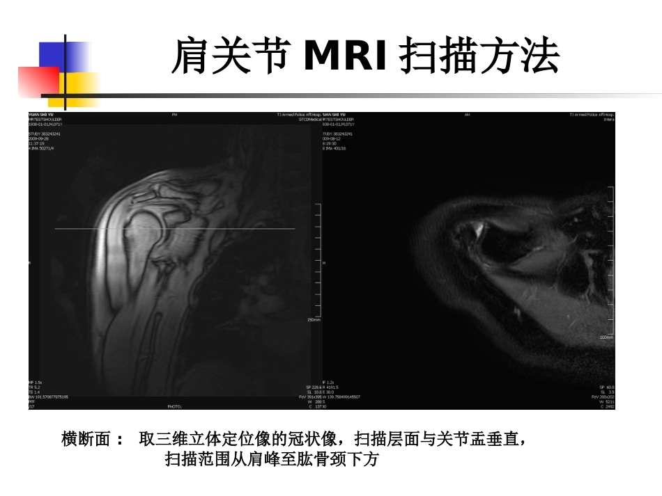 肩关节病变MRI解剖和诊断课件_第5页