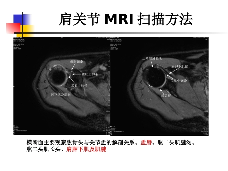 肩关节病变MRI解剖和诊断课件_第6页