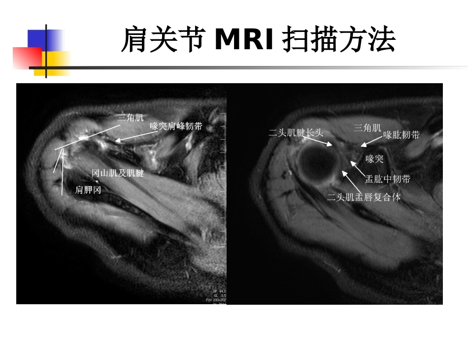 肩关节病变MRI解剖和诊断课件_第7页