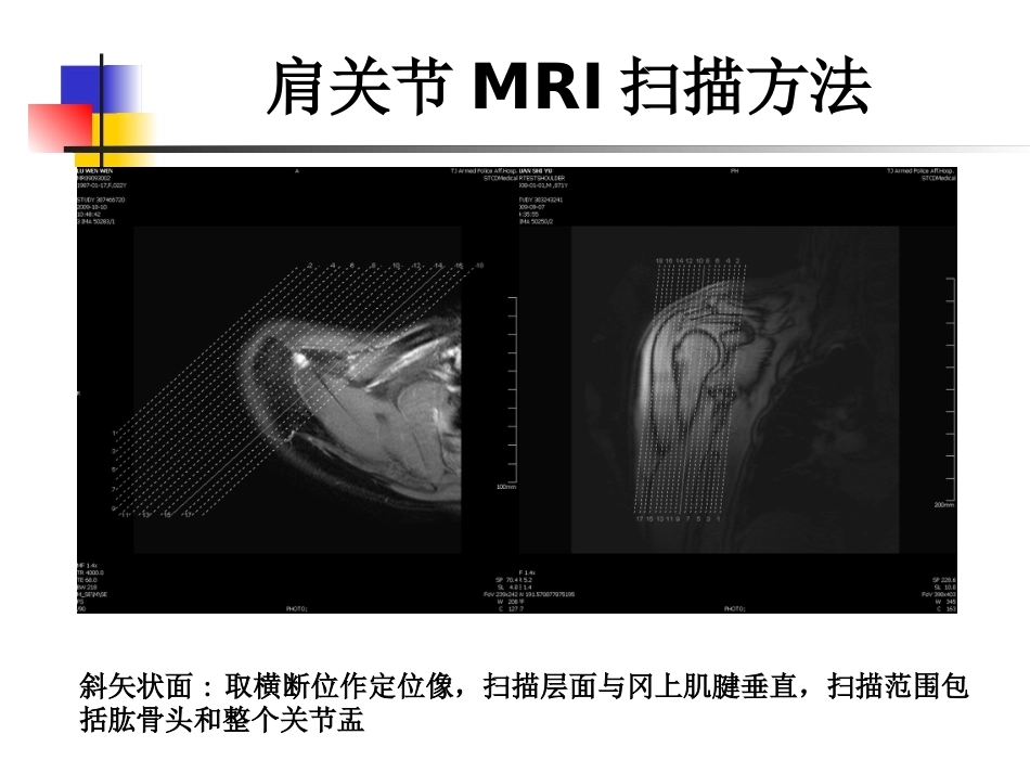 肩关节病变MRI解剖和诊断课件_第8页
