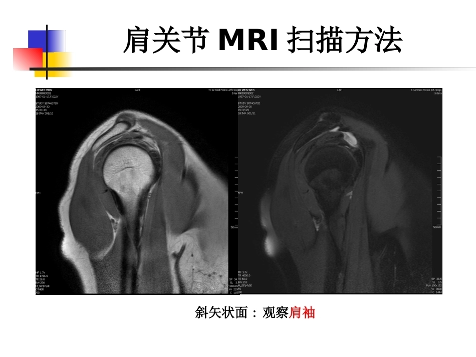 肩关节病变MRI解剖和诊断课件_第9页