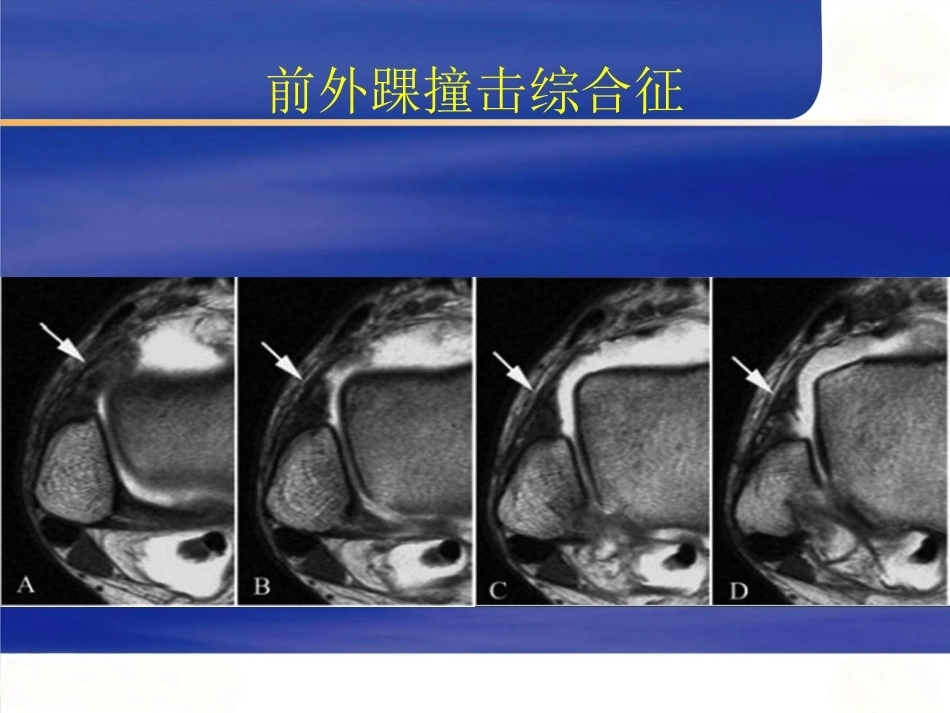 踝关节撞击综合征影像学(2)_第11页