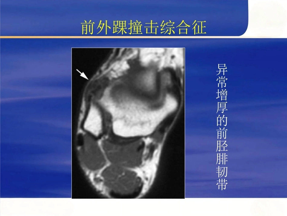 踝关节撞击综合征影像学(2)_第12页