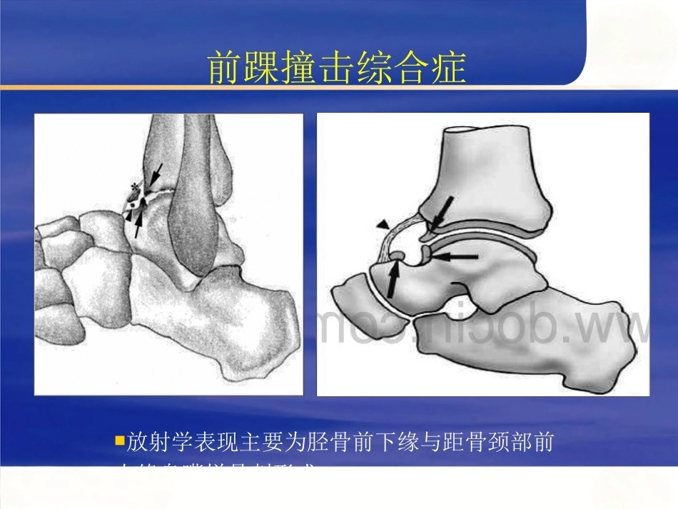 踝关节撞击综合征影像学(2)_第14页