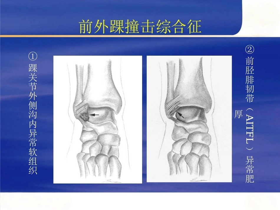 踝关节撞击综合征影像学(2)_第9页
