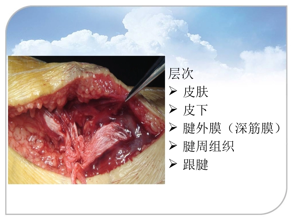 跟腱断裂的诊断与治疗(2)_第6页