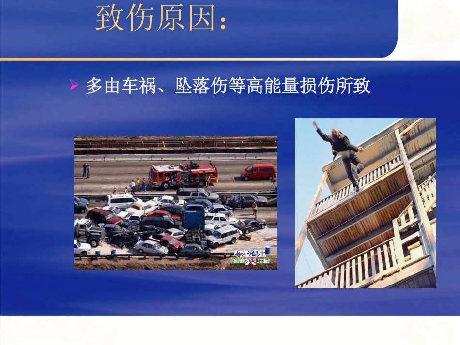 Pilon骨折的治疗(2)_第3页