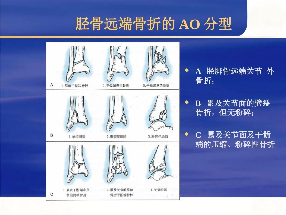 Pilon骨折的治疗(2)_第8页