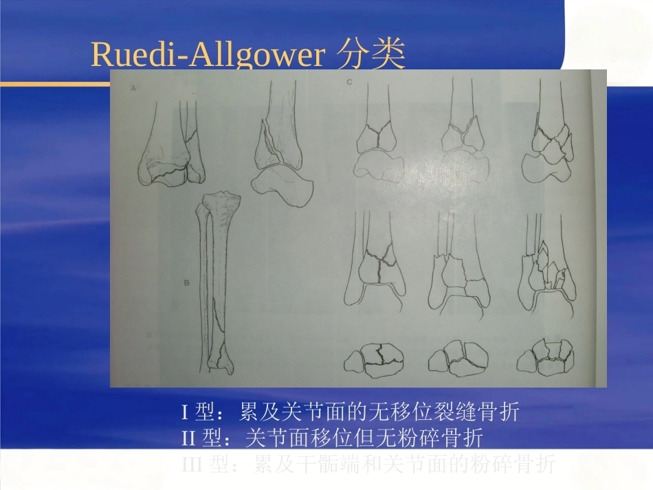 Pilon骨折的治疗(2)_第9页