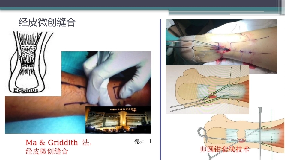 跟腱断裂修复存在的问题及解决新策略(2)_第5页