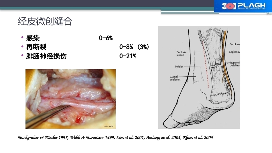 跟腱断裂修复存在的问题及解决新策略(2)_第6页