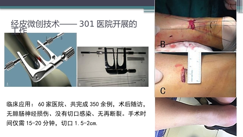 跟腱断裂修复存在的问题及解决新策略(2)_第9页
