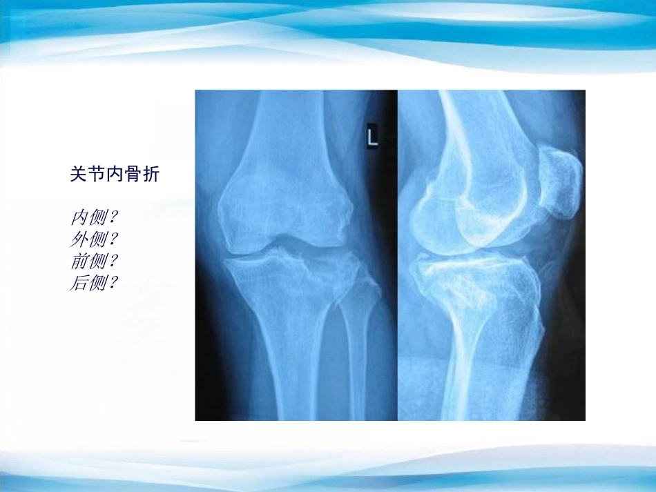 创伤骨科X线片阅片技巧及易漏诊病例讨论(2)_第12页