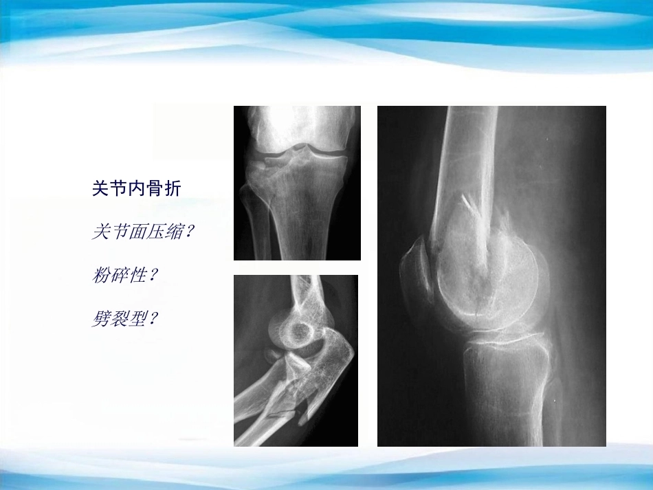 创伤骨科X线片阅片技巧及易漏诊病例讨论(2)_第13页