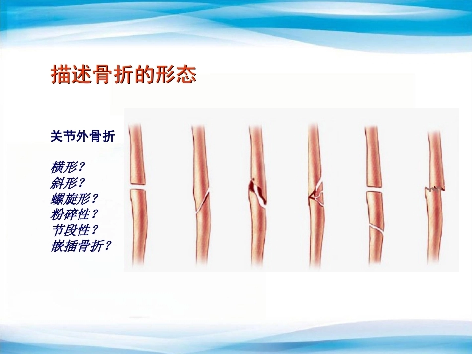 创伤骨科X线片阅片技巧及易漏诊病例讨论(2)_第14页