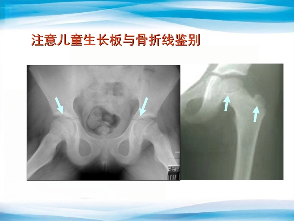 创伤骨科X线片阅片技巧及易漏诊病例讨论(2)_第15页