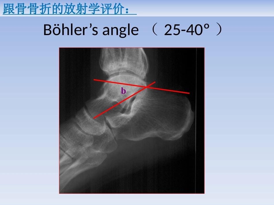 跟骨骨折的治疗(2)_第10页