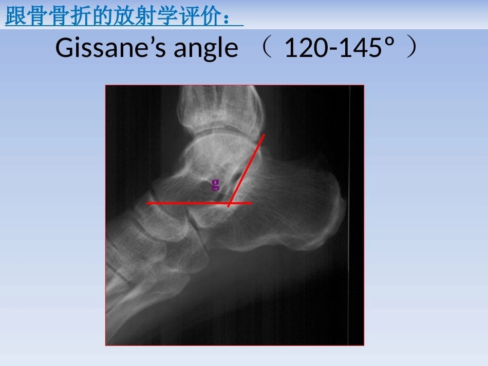 跟骨骨折的治疗(2)_第11页