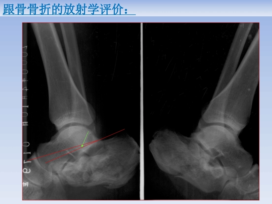 跟骨骨折的治疗(2)_第12页