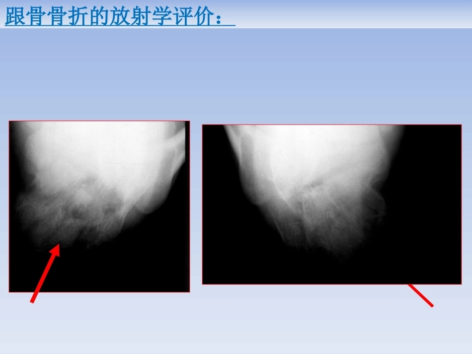 跟骨骨折的治疗(2)_第13页