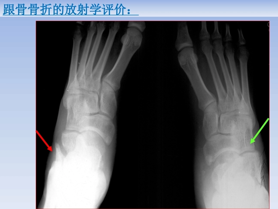 跟骨骨折的治疗(2)_第14页