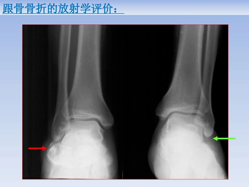跟骨骨折的治疗(2)_第15页