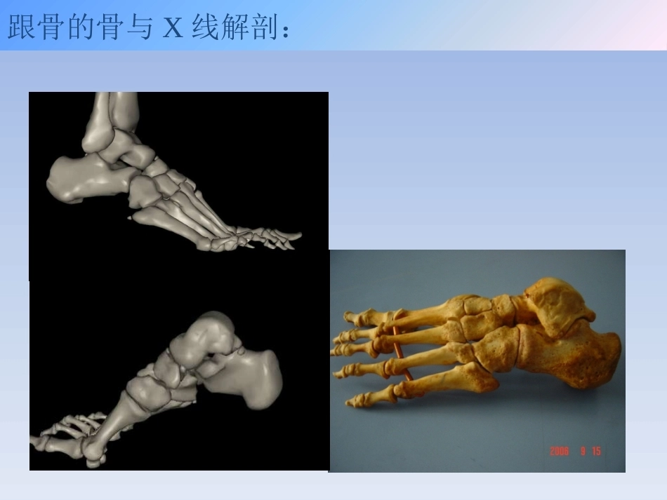 跟骨骨折的治疗(2)_第3页
