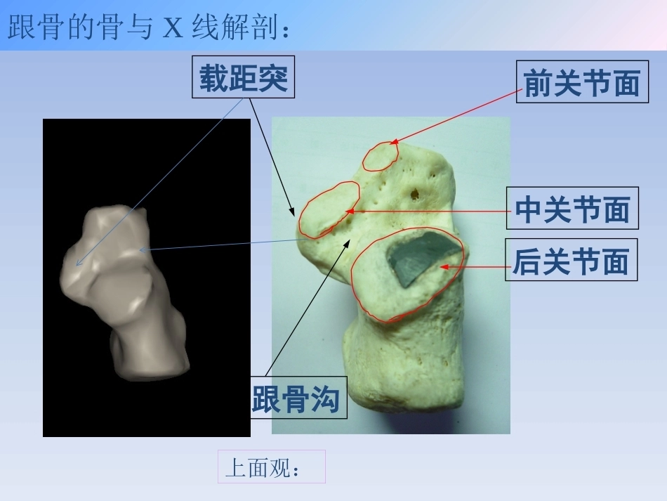 跟骨骨折的治疗(2)_第4页