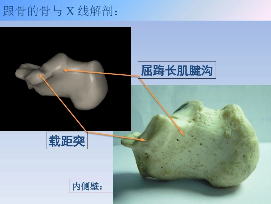 跟骨骨折的治疗(2)_第5页