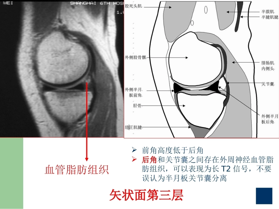 膝关节半月板损伤MRI诊断PPT(2)_第10页