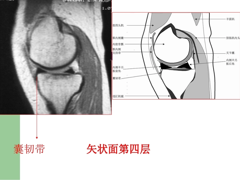 膝关节半月板损伤MRI诊断PPT(2)_第11页