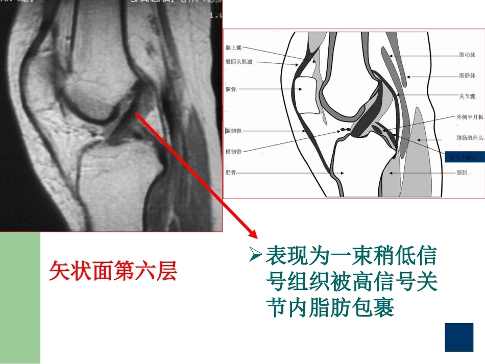 膝关节半月板损伤MRI诊断PPT(2)_第13页