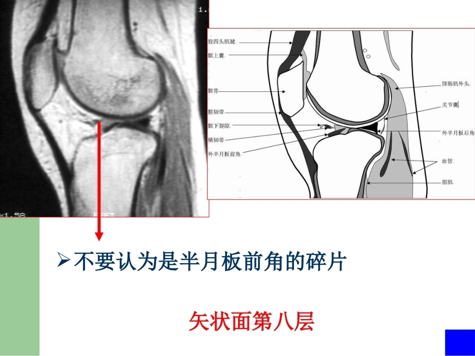 膝关节半月板损伤MRI诊断PPT(2)_第15页
