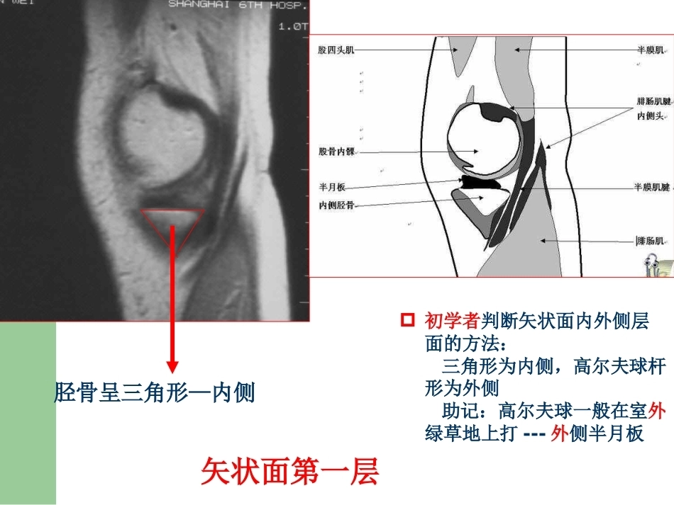 膝关节半月板损伤MRI诊断PPT(2)_第8页