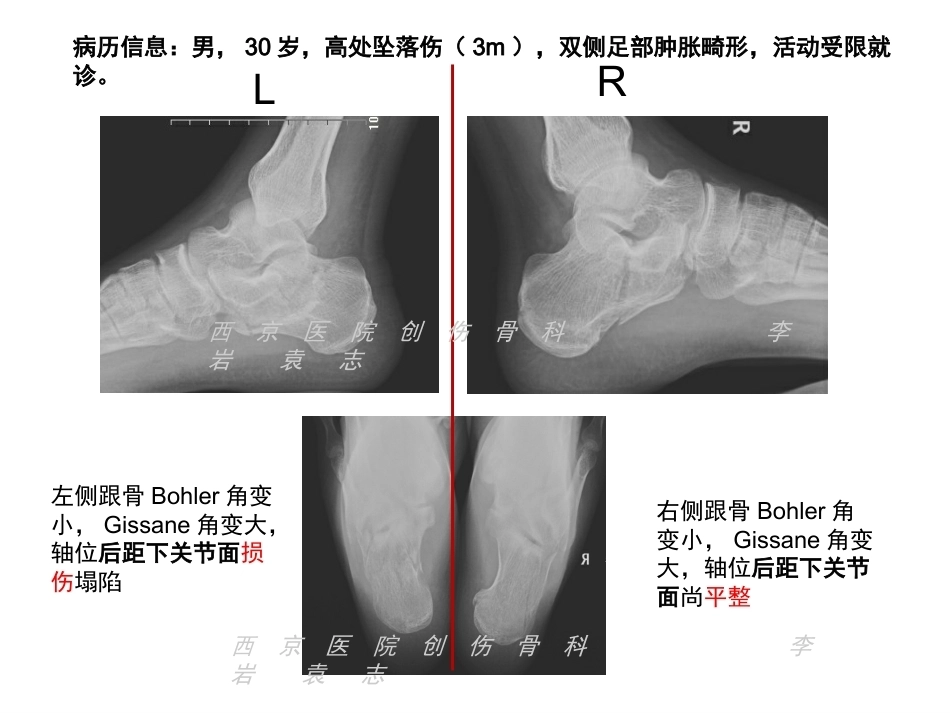 跟骨骨折微创治疗(2)_第2页