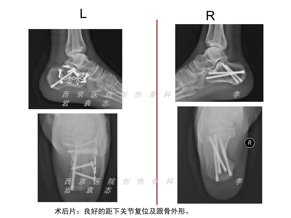 跟骨骨折微创治疗(2)_第7页