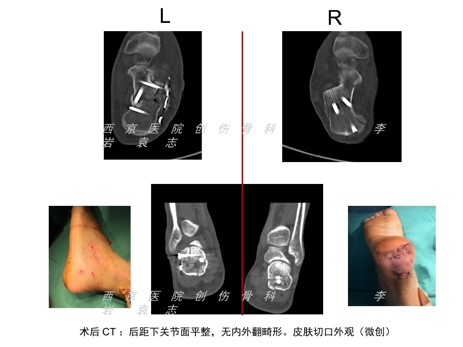 跟骨骨折微创治疗(2)_第8页