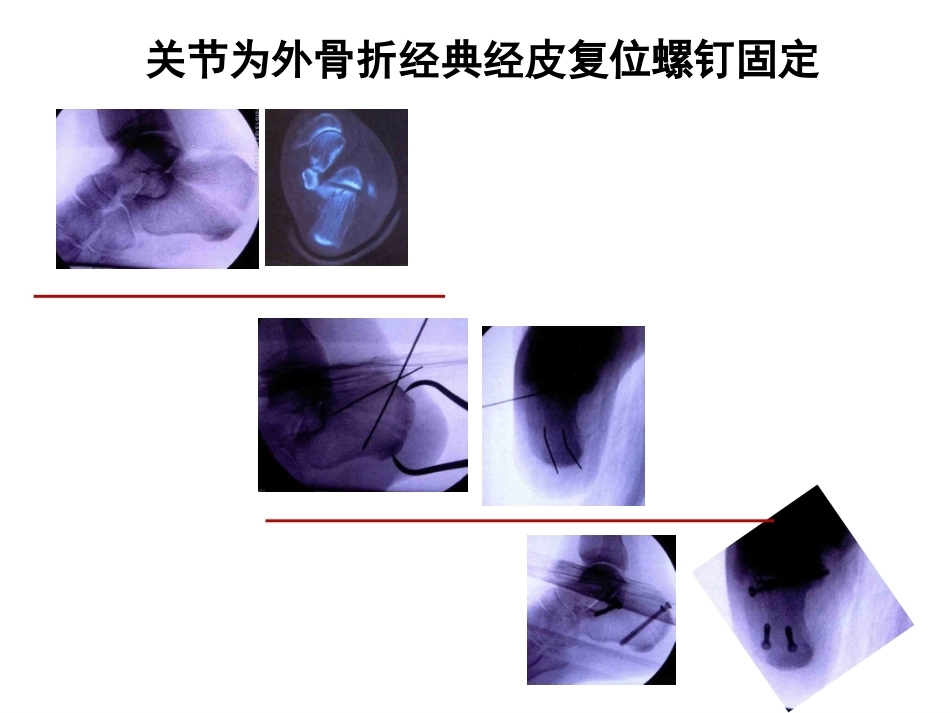 跟骨骨折微创治疗(2)_第9页