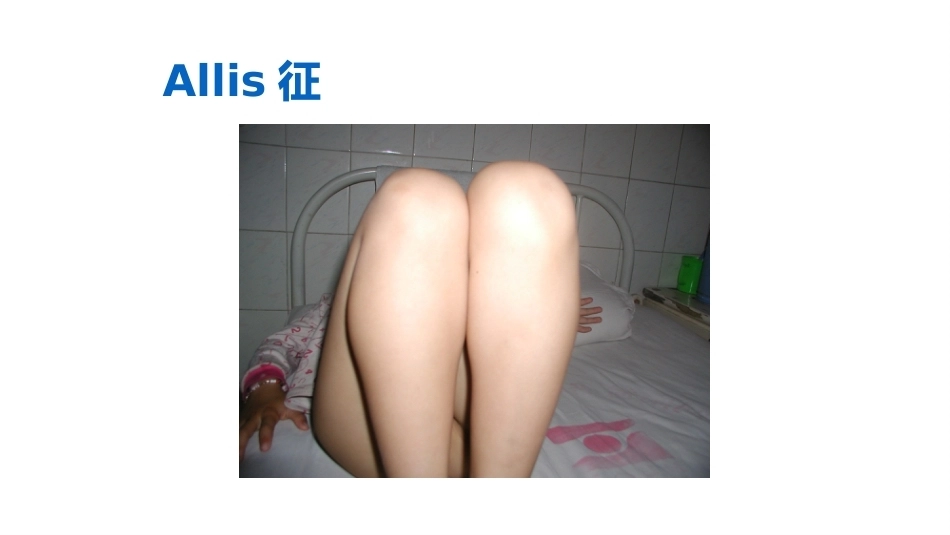 先天性髋关节脱位的X线诊断(2)_第11页