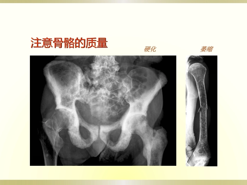 骨科读片基础(2)_第14页