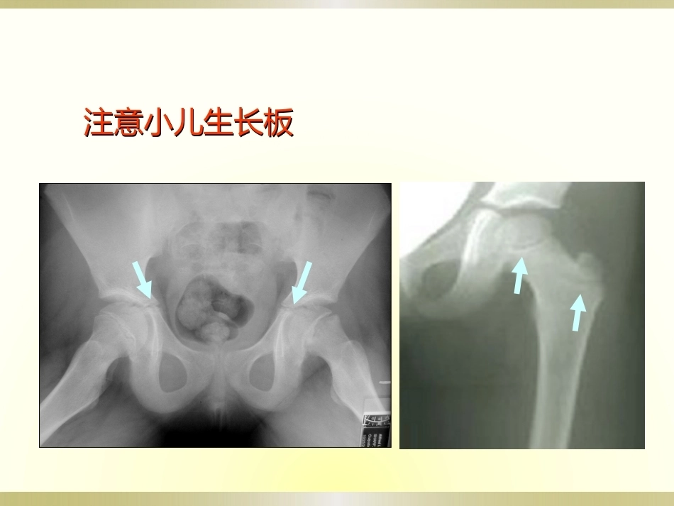 骨科读片基础(2)_第15页