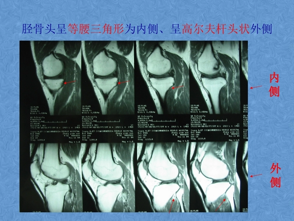 膝关节高清MRI解剖(2)_第6页