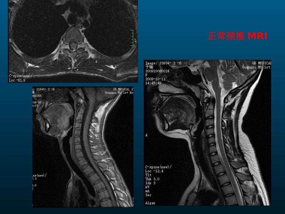 颈椎病的MRI诊断(2)_第10页